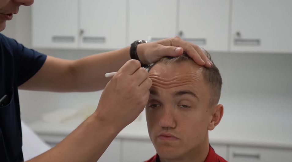 Mini Majk przeszczepił sobie włosy