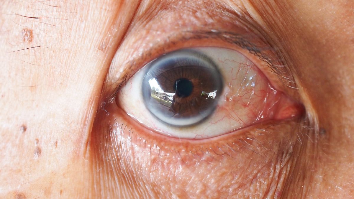 Szary pierścień wokół tęczówki. Co mówi o zdrowiu?