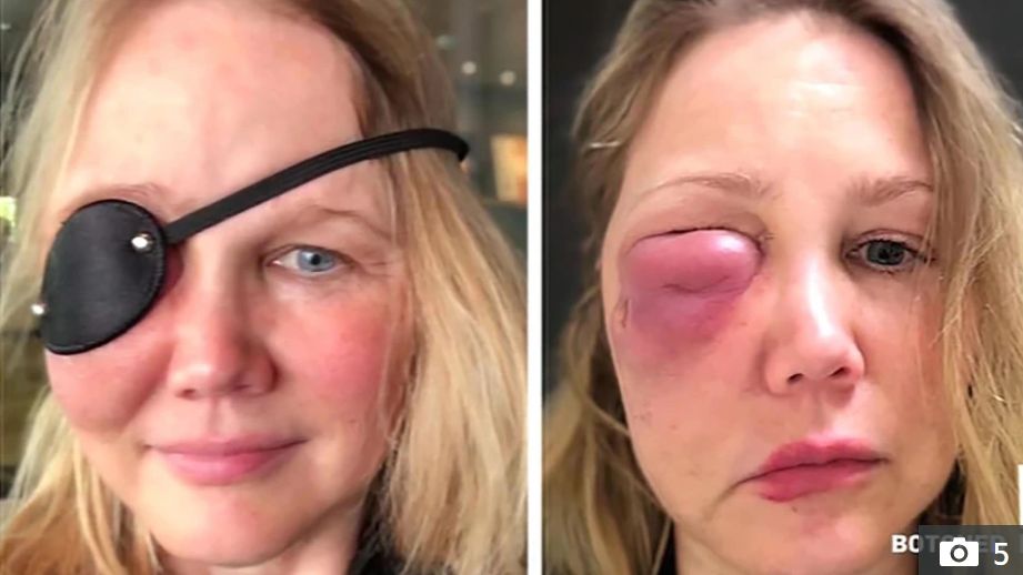 Chciała poprawić urodę na 40. urodziny. Po wstrzyknięciu silikonu została z dziurą w twarzy
