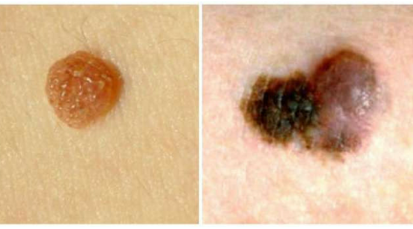 Kolor pieprzyka i znamion na skórze