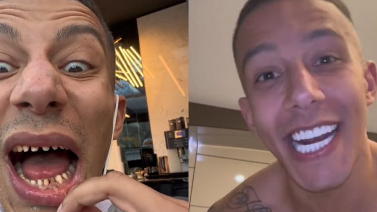 Mężczyzna zrobił sobie nowe zęby. 