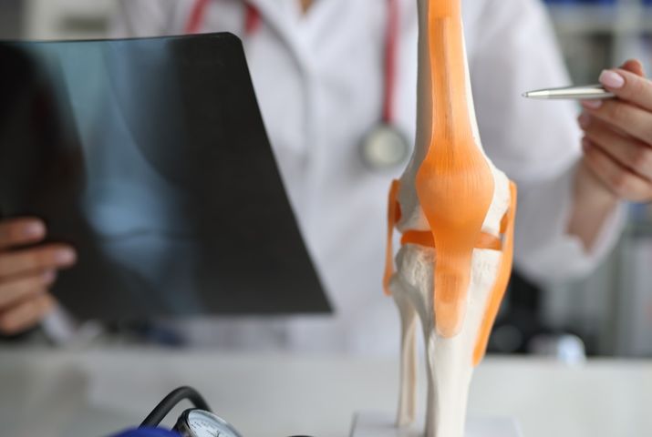 Osteoliza to patologia, istotą której jest rozpuszczanie kości.