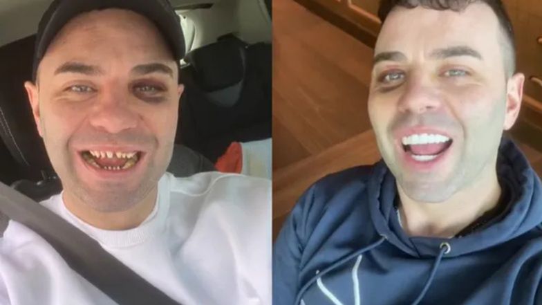 Zrobił sobie "tureckie zęby"