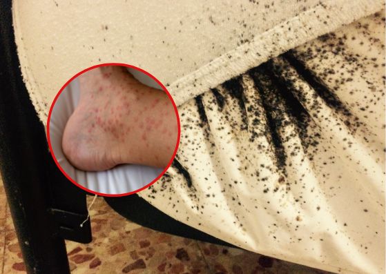 Pluskwy pogryzły dziewczynkę z Olsztyna