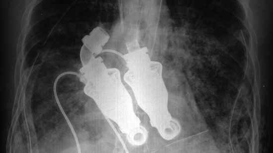 Można już żyć bez pulsu 1