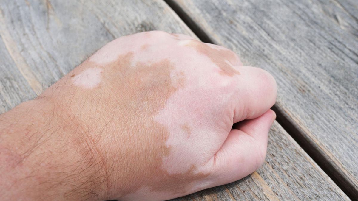 Białe plamy na skórze powstają w wyniku zaburzenia produkcji melaniny. 