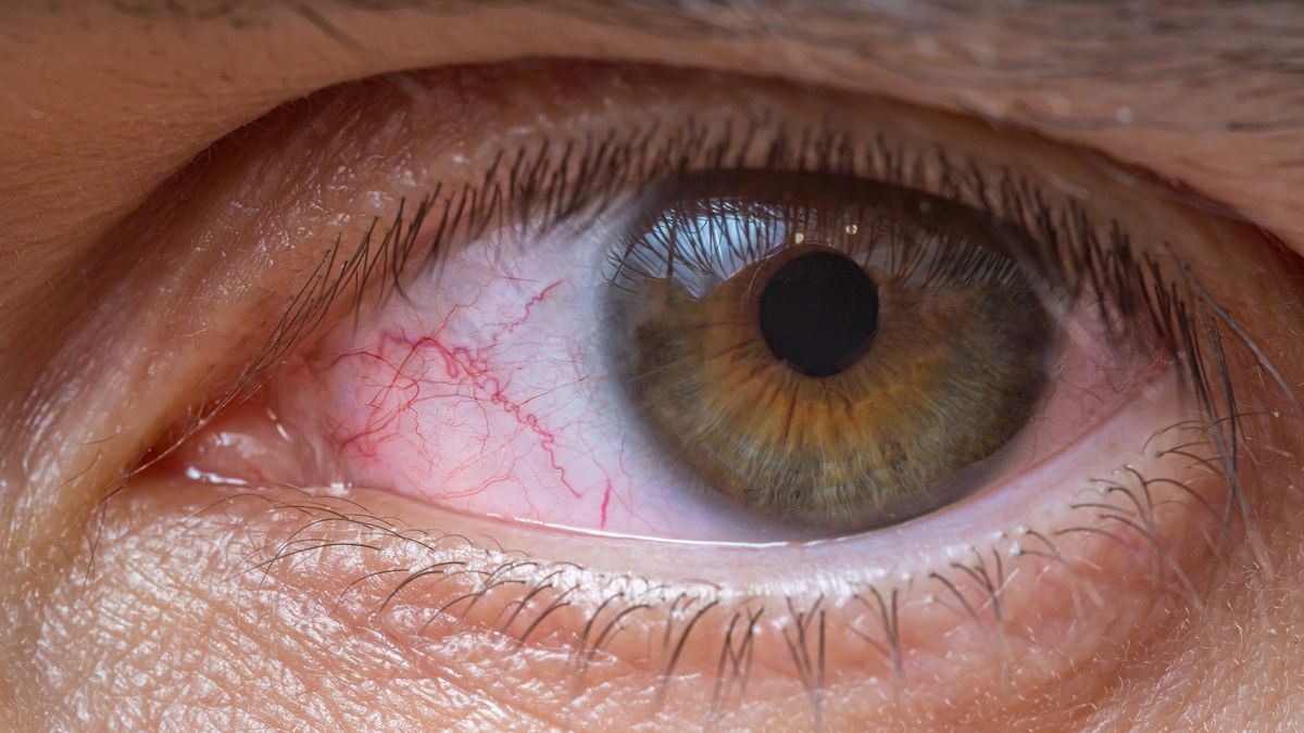 Zapalenie spojówek jest jednym z objawów COVID-19