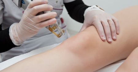 Depilacja laserowa – sposób na trwałe usunięcie owłosienia