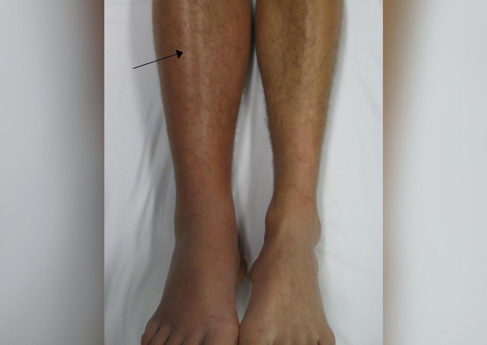 Wygląd nogi z zapaleniem żył głębokich (James Heilman, MD, lic. CC BY-SA 3.0)
