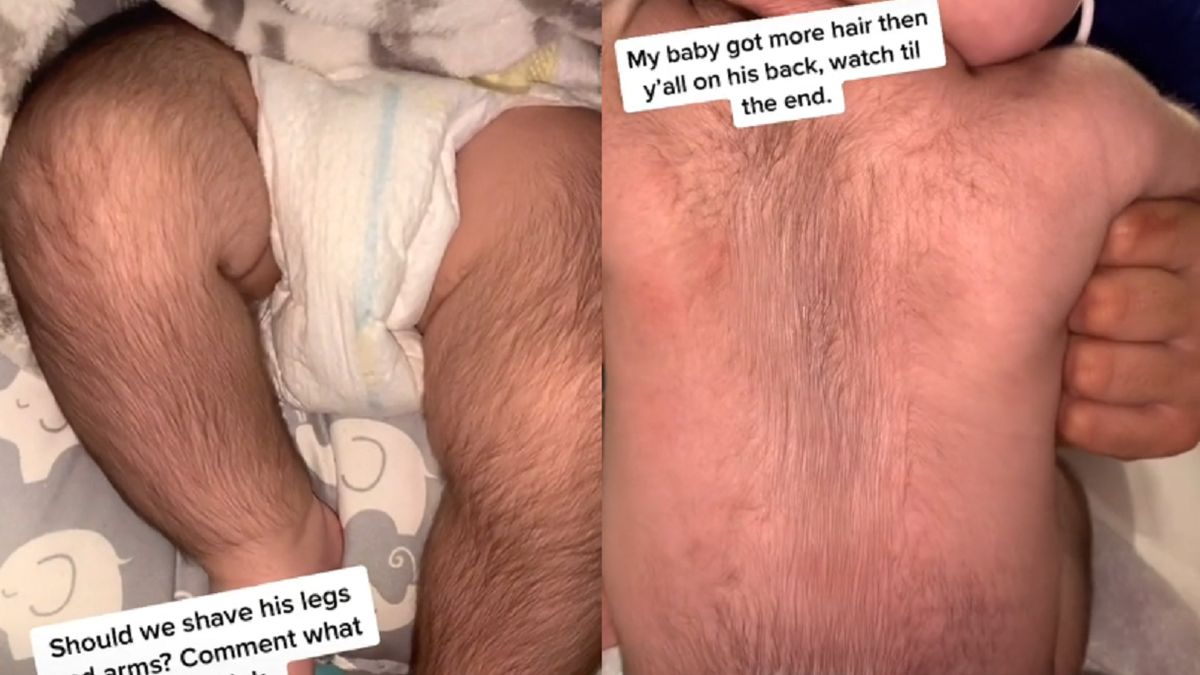 Dziecko ma wyjątkowo silne owłosienie.