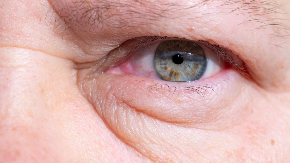 Opuchnięte powieki mogą być objawem wielu chorób i schorzeń, zarówno tych dotyczących oczu, jak i ogólnoustrojowych.