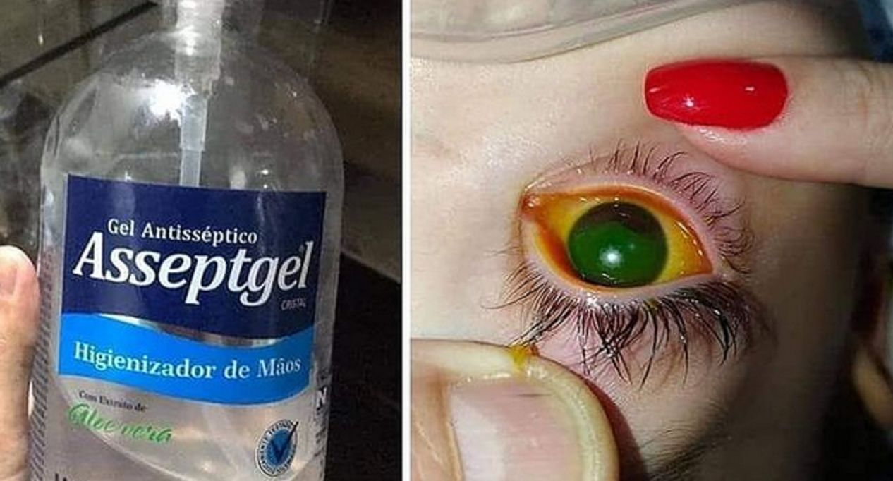 Żel do dezynfekcji spalił mu rogówkę. Chłopiec trafił do szpitala