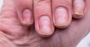 Znak choroby na paznokciach. Zagrożone serce, nerki lub wątroba