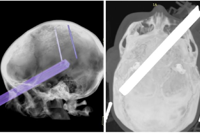 Wynik badania TK Zofii Zwolińskiej w dniu wypadku 