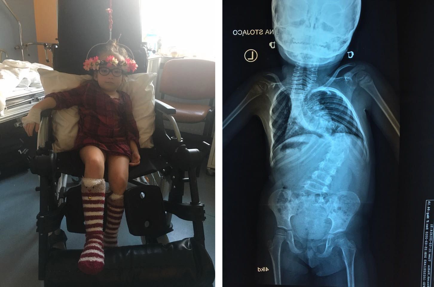 Na operację ratującej zdrowie i życie dziecka brakuje wciąż pół miliona złotych 