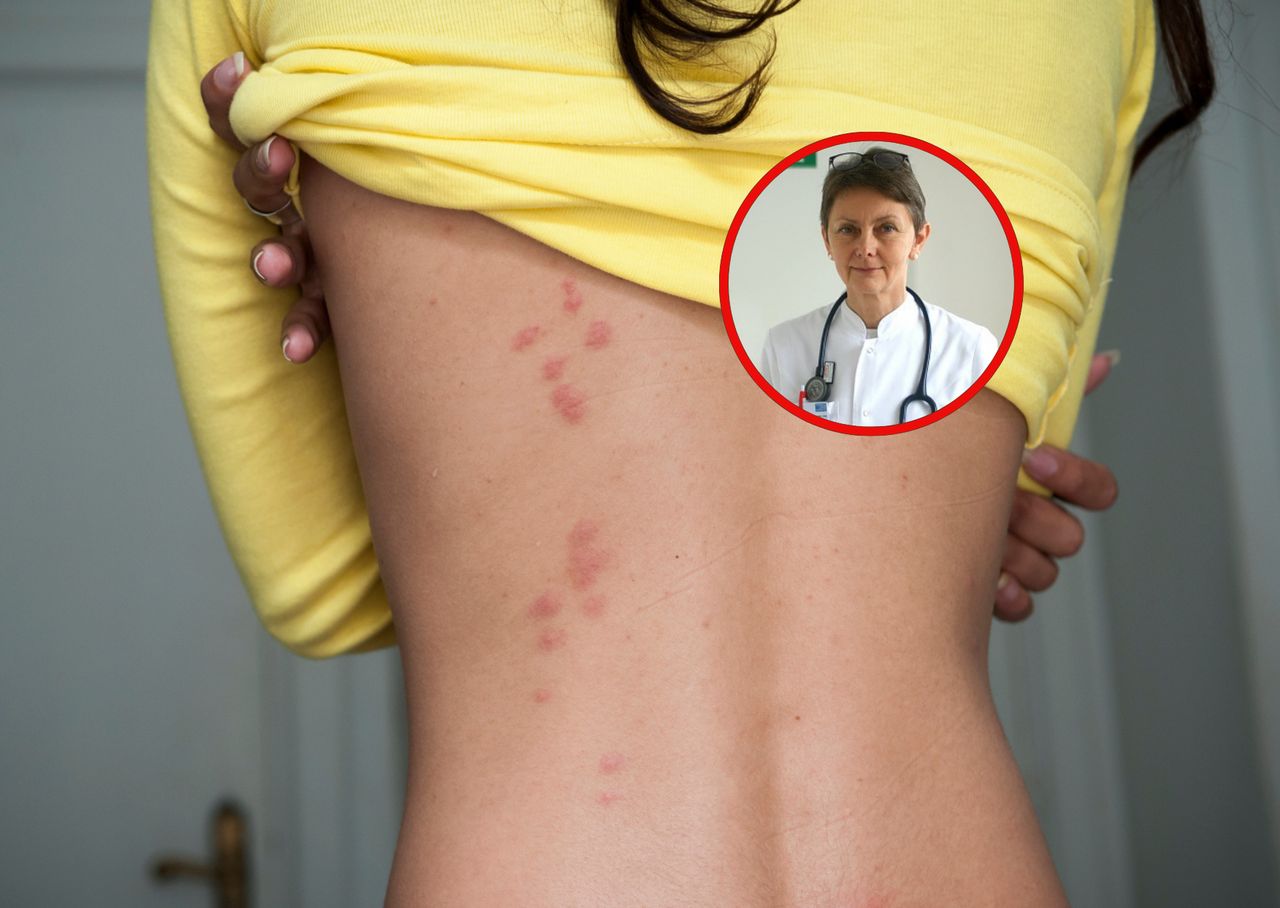 "Reaktywacja wirusa". Co roku choruje nawet 142 tys. Polaków