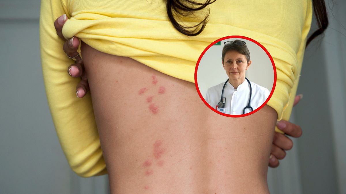 Półpasiec może dotknąć co trzeciego z nas