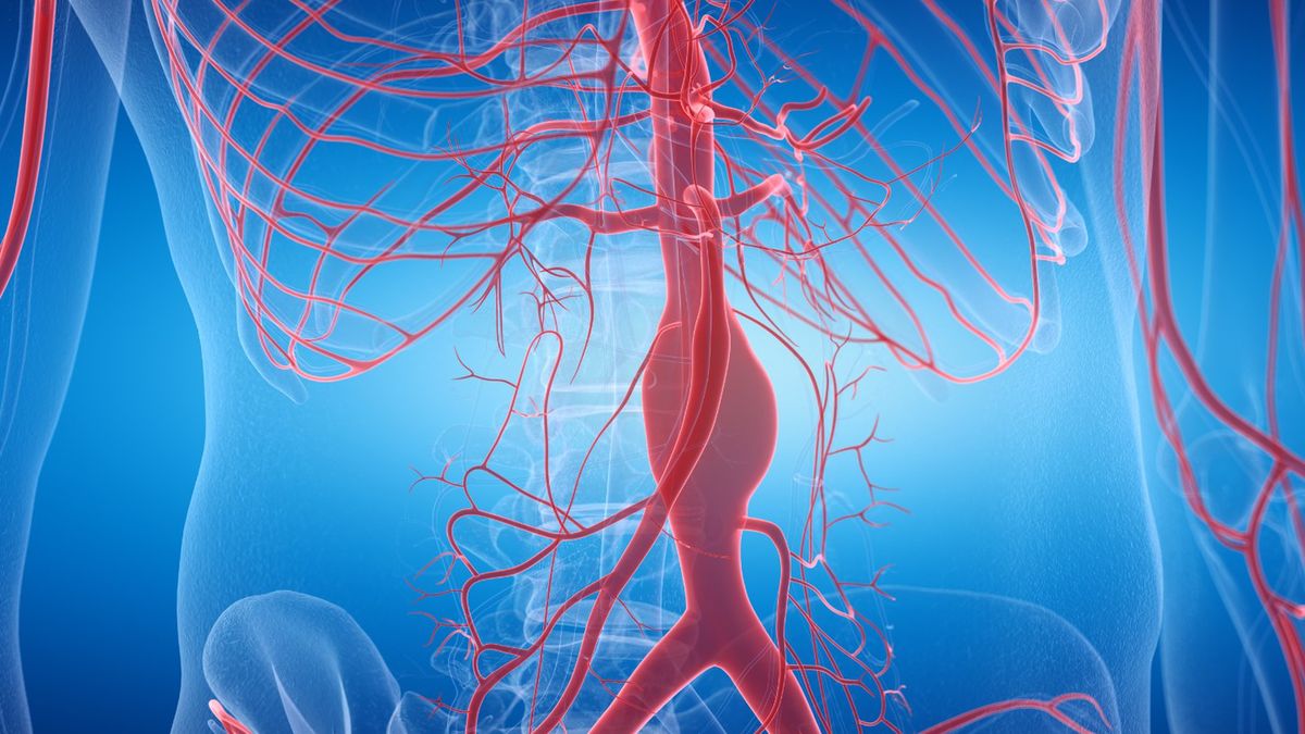 Zabieg operacyjny tętniaka aorty