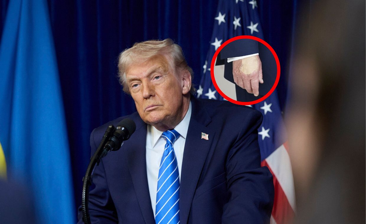 wiadomości,aktualności,WP Wiadomości Siniaki na dłoni. Wracają pytania o zdrowie Trumpa