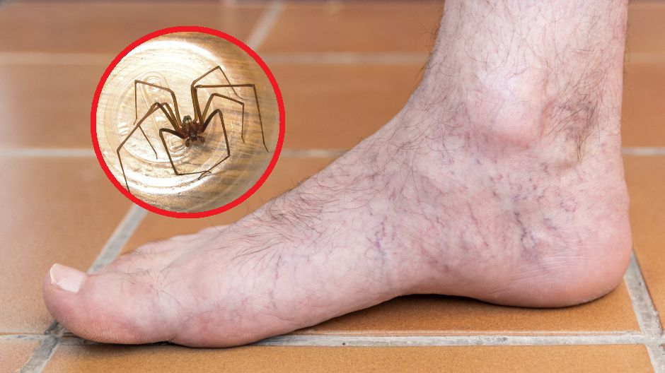 Nawracający problem mężczyzny może być spowodowany ukąszeniem pająka