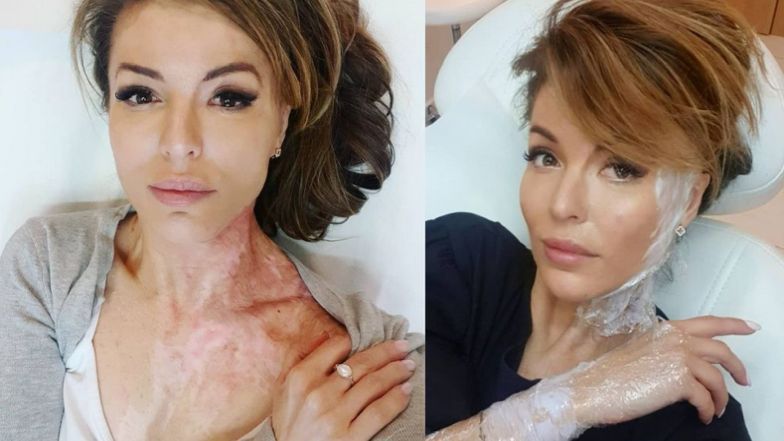 Katarzyna Dacyszyn pokazuje rekonwalescencję po oblaniu kwasem