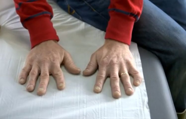 Zmiany przy paznokciach. Czego mogą być objawem? (WIDEO)