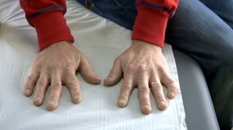 Mężczyzna szukał przyczyny zmian na paznokciach 