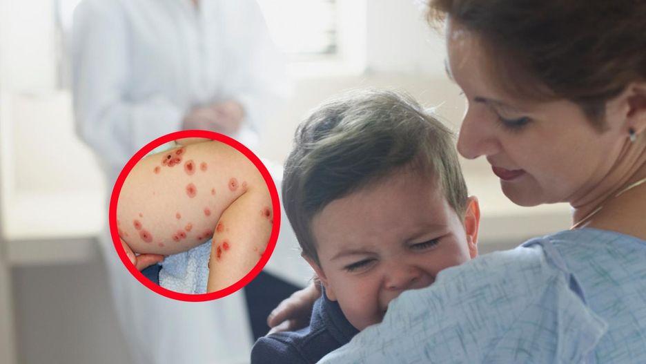 Na ciele dwulatka nagle pojawiły się czerwone plamy. To był objaw rzadkiej choroby