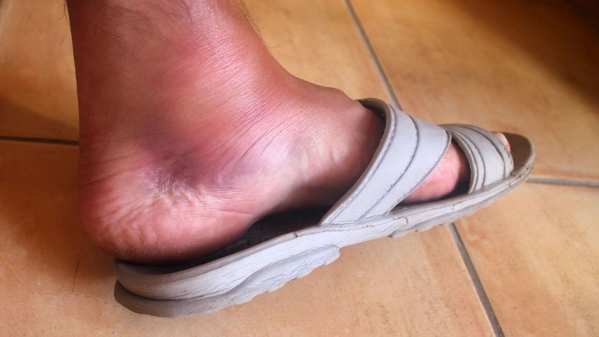 Jednym z objawów chłoniaka jest opchlizna kończyn dolnych