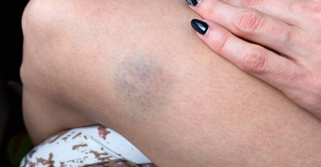 Siniaki bez powodu? To może być objaw wielu chorób
