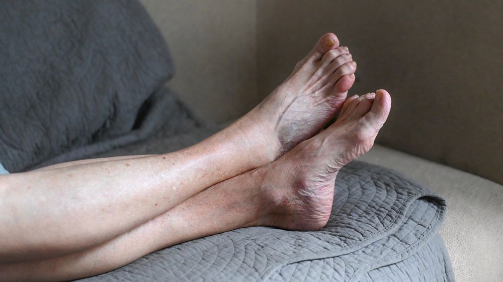 Nieleczona niszczy organizm. Może prowadzić do amputacji