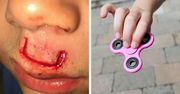 Fidget Spinner znowu zbiera żniwo. Tym razem pokaleczył dziecku twarz