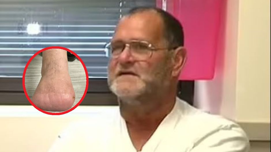 Ugryzienie kleszcza doprowadziło do niebezpiecznej infekcji. Konieczna był amputacja wszystkich palców stopy