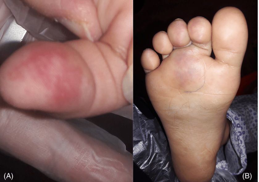 Zmiany przypominające odmrożenia na palcu i stopie