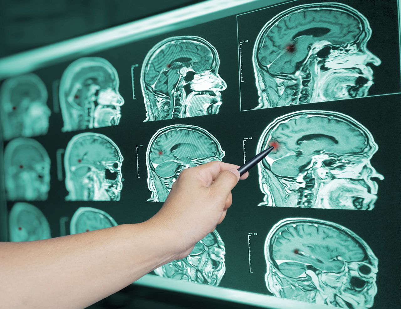 Hidden dangers: How to recognize the subtle signs of a brain tumour