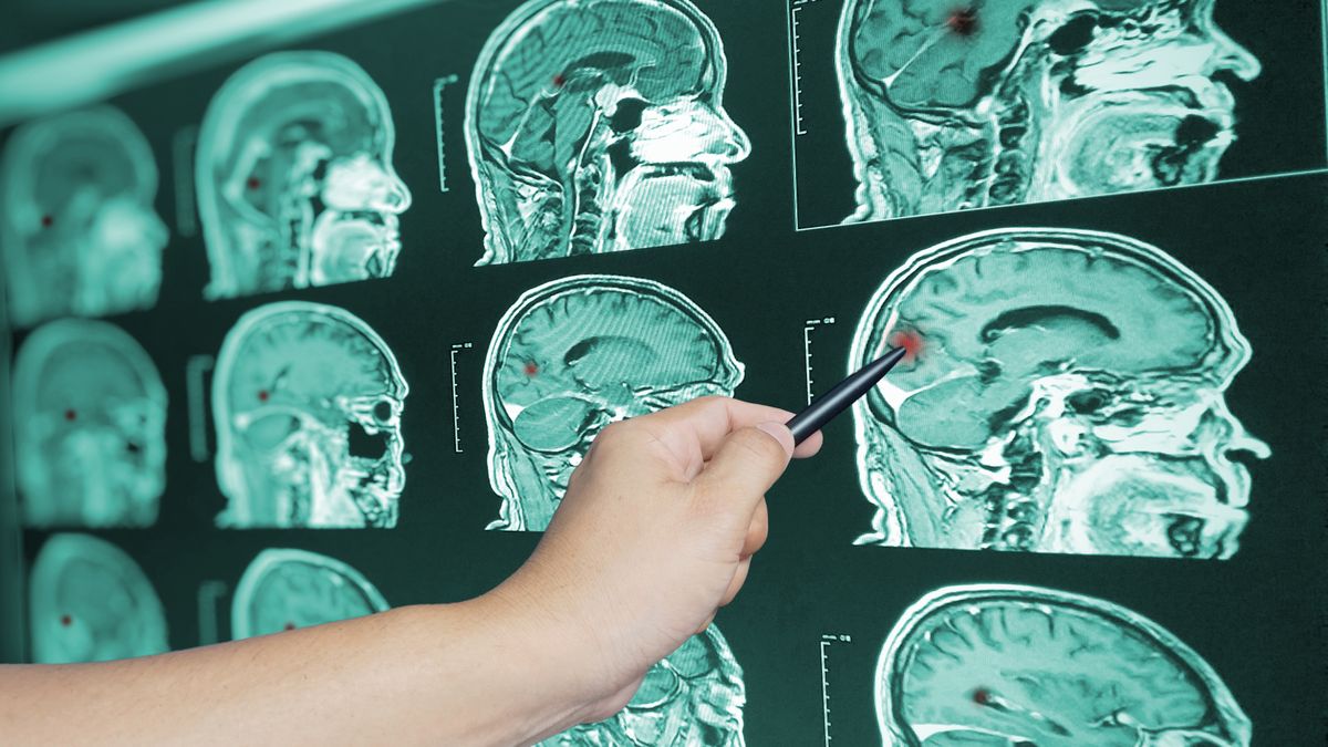 Pierwszy objaw guza mózgu. Jak go rozpoznać?