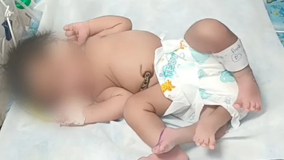 Dziewczynka z czterema nogami. Niezwykły poród