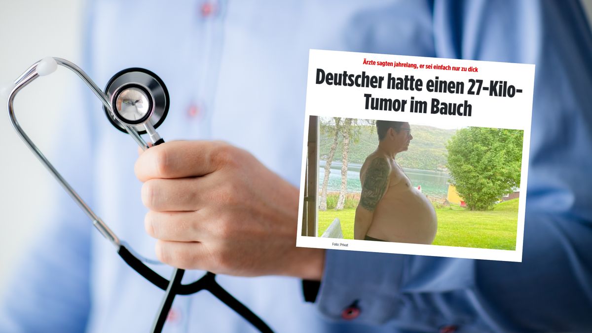 Blisko 30-kilogramowy guz w żołądku Niemca