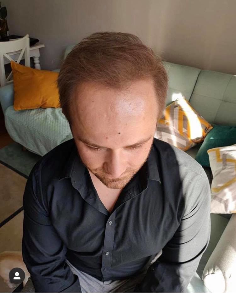 Adrian ze "Ślubu" pokazuje efekty przeszczepu włosów