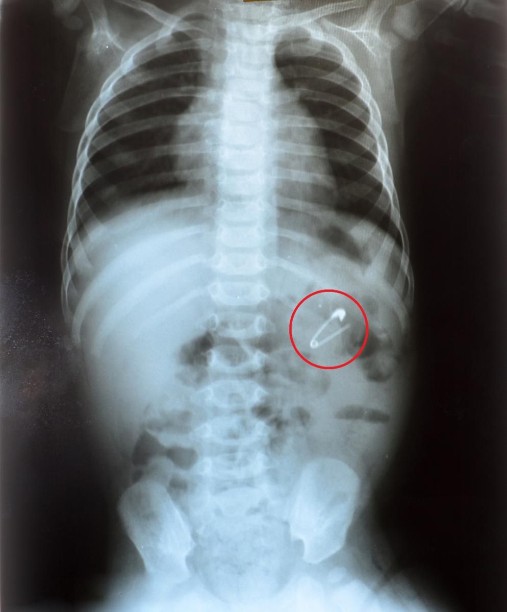 Krotoszyn. Dziecko połknęło agrafkę. Lekarka odesłała je do innego szpitala