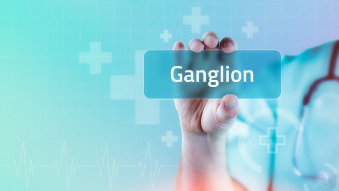 Ganglion to torbiel wypełniona płynem, powstająca w okolicy ścięgien i stawów