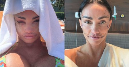 Katie Price pokazała, jak zmieniała się jej twarz po SZÓSTYM liftingu. Internauci nie dowierzają: "Niszczysz siebie"