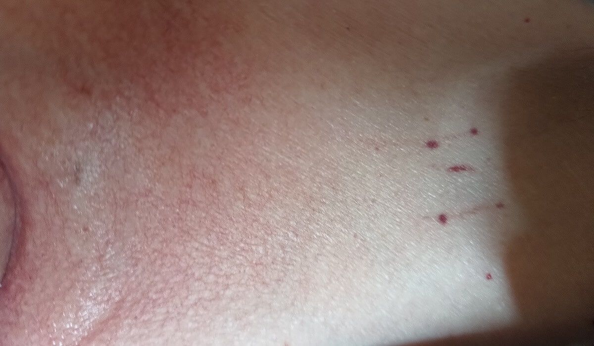 Ślady po paznokciach personelu (mama nie jest w stanie sama tego dokonać, bo ma niedowład kończyn)