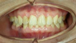 Zgryz głęboki - leczenie, rysy twarzy i przyczyny wady