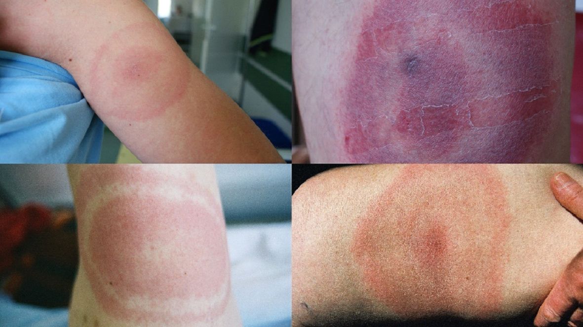 Rumień w kształcie tarczy strzelniczej