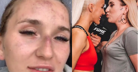 Dumna Marta Linkiewicz pokazała twarz po walce z Sex Masterką: "Nigdy tak zaje**ście nie wyglądałam"