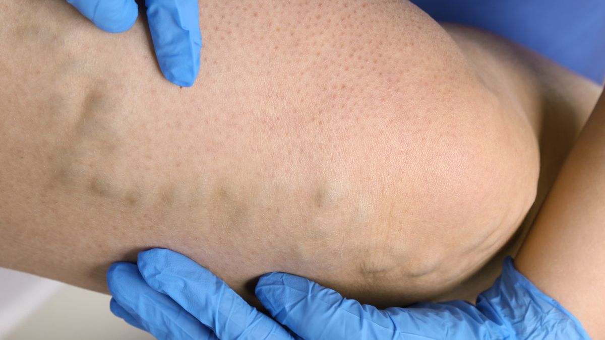 Uczucie ciepła w nogach jest wrażeniem, które wywołuje dyskomfort, ale i niepokój.