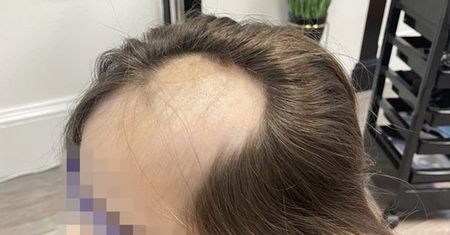 Nachyliła się nad mikserem. Dziewczynka straciła włosy