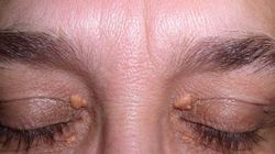 Zmiany na skórze mogą być sygnałem problemów z sercem. Nie lekceważ