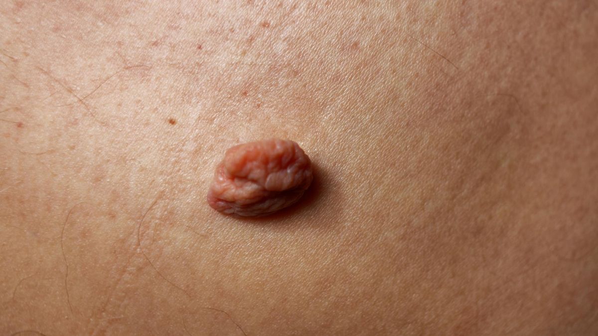 Verrumal to płyn przypisywane przez dermatologów w leczeniu brodawek.